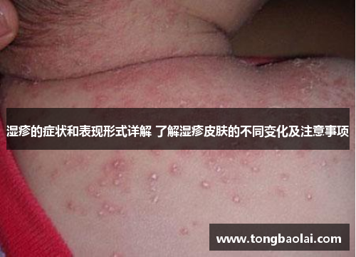 湿疹的症状和表现形式详解 了解湿疹皮肤的不同变化及注意事项